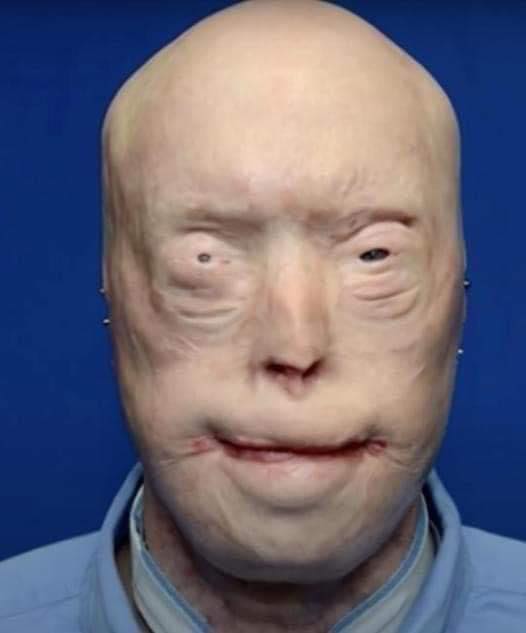 The Fire That Stole His Face and the Extraordinary Gift That Gave Him Back His Life