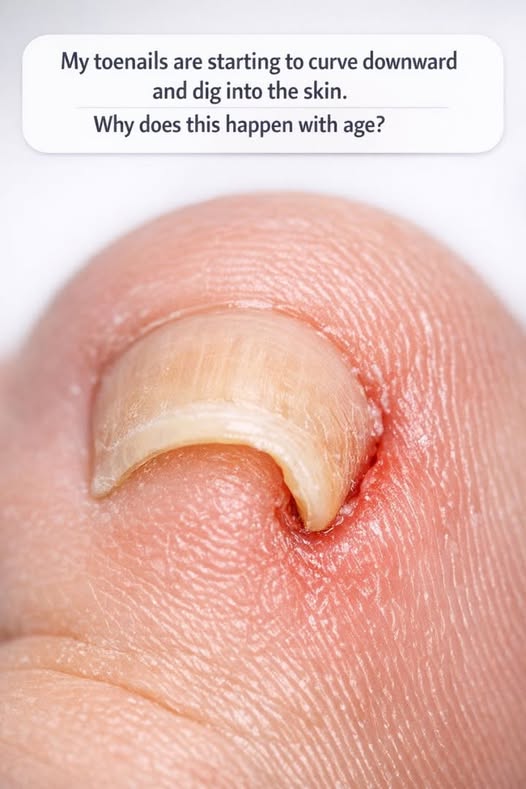 My toenails are starting to curve downward and dig into the skin. Why does this happen with age?
