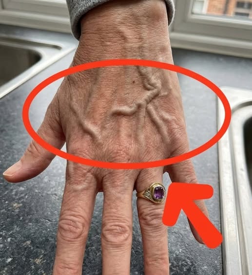 If Someone Has Visible Veins, Does It Mean Their Circulation Is Poor?