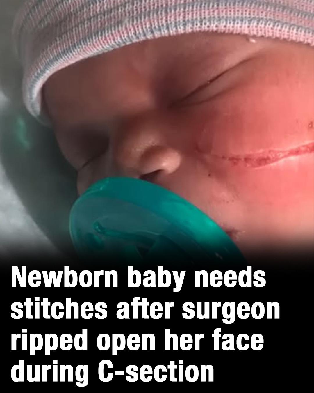 Newborn baby needs 13 stitches after surgeon ripped open her face during C-section