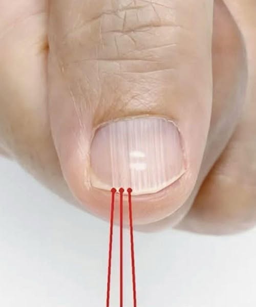 What Vertical Nail Ridges Can Tell You About Nail Health